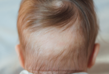 Yenidoğan Bebeklerde Saç Dökülmesi Nedenleri